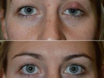 Blepharoplasty before and after results at Italian Eye Hospital, upper eyelid correction outcome