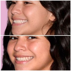 Résultats avant et après Invisalign chez YeahSmile – alignement dentaire et sourire améliorés