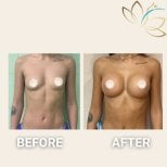 Before and after breast lift results at EDEN AESTHETICS, visible breast contour improvement