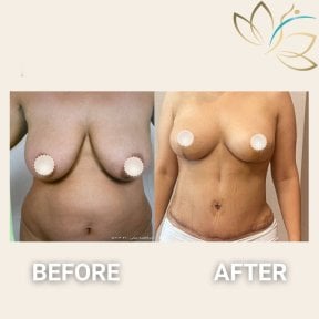 Before and after breast lift results at EDEN AESTHETICS, visible breast contour improvement