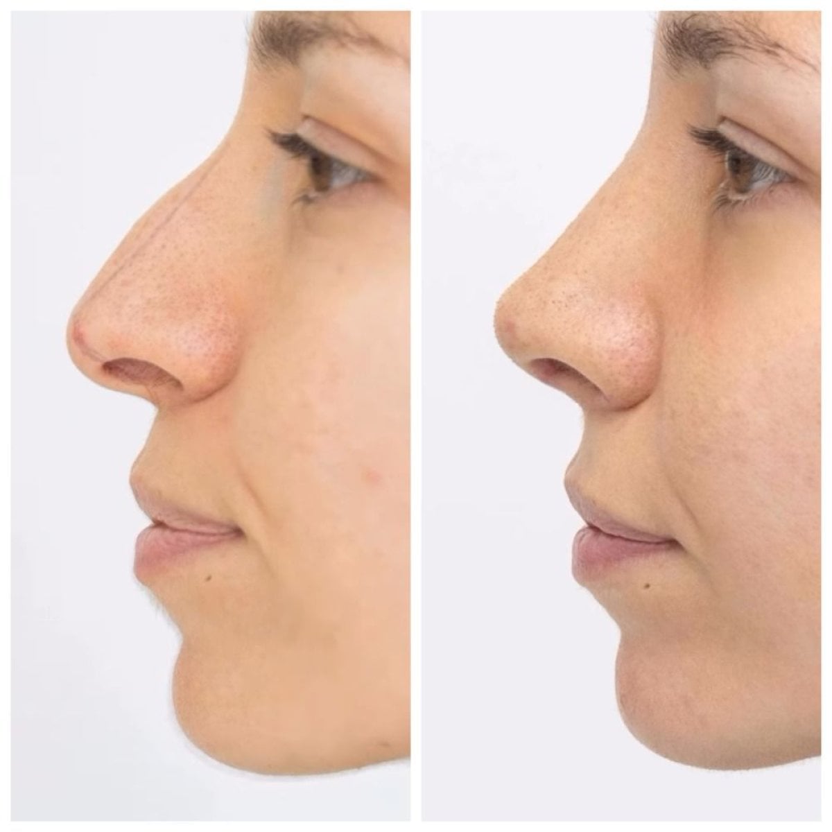 نتائج عملية تجميل الأنف قبل وبعد في EDEN AESTHETICS، إعادة تشكيل الأنف بمظهر طبيعي