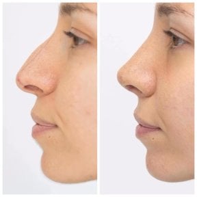 Результаты ринопластики до и после в EDEN AESTHETICS, естественная коррекция носа