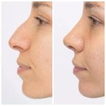 Результаты ринопластики до и после в EDEN AESTHETICS, естественная коррекция носа