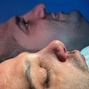 Результаты ринопластики до и после для мужчины в EDEN AESTHETICS, коррекция носа