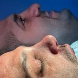 Результаты ринопластики до и после для мужчины в EDEN AESTHETICS, коррекция носа