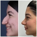 Результаты ринопластики до и после в EDEN AESTHETICS, естественная коррекция носа