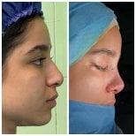 Результаты ринопластики до и после в EDEN AESTHETICS, естественный профиль носа