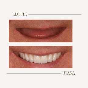 Before and after dental implant results at BMC Dental Klinik, restored smile transformation