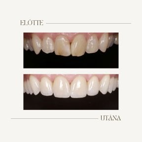 Before and after dental implant results at BMC Dental Klinik, restored natural smile