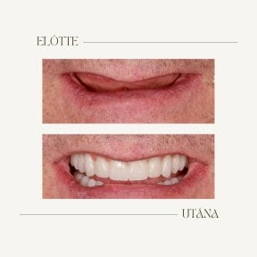 Before and after dental implant results at BMC Dental Klinik, restored smile transformation