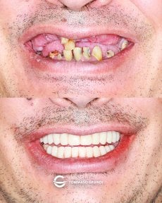 قبل وبعد أطقم الأسنان الثابتة على زرعات الزركونيا في Tommaso Grandi Dental Clinic