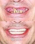 قبل وبعد أطقم الأسنان الثابتة على زرعات الزركونيا في Tommaso Grandi Dental Clinic