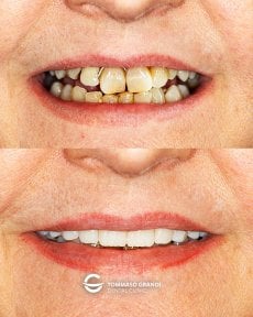 نتائج قبل وبعد طقم أسنان زركونيا كامل في Tommaso Grandi Dental Clinic