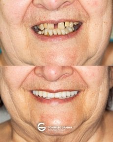 نتيجة قبل وبعد أطقم الزركونيا الكاملة على الغرسات في عيادة Tommaso Grandi