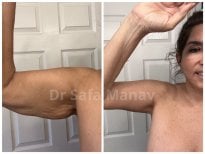 Before and after arm lift (brachioplasty) results at Dr. Safa Manav Clinic, tighter upper arms
