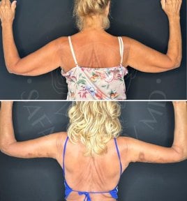 Before and after arm lift results at Dr. Safa Manav Clinic, improved upper arm contour