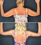 Before and after arm lift results at Dr. Safa Manav Clinic, improved upper arm contour