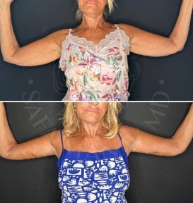 Before and after arm lift results at Dr. Safa Manav Clinic, improved upper arm contour