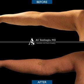 Before and after arm lift (brachioplasty) results at Dr. Safa Manav Clinic, improved contour