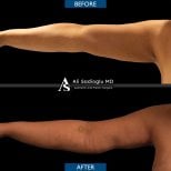 Before and after arm lift (brachioplasty) results at Dr. Safa Manav Clinic, improved contour