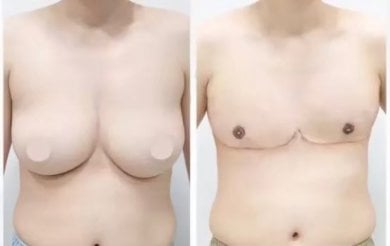Before and after top surgery results at ID Clinic Bangkok – chest masculinization outcome