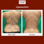 نتائج شفط الدهون قبل وبعد في عيادة DGB، تحسين واضح في شكل الظهر