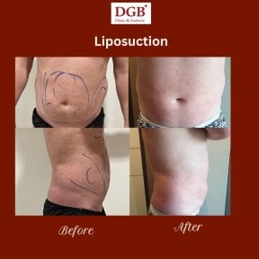 نتائج شفط الدهون قبل وبعد في عيادة DGB، تحسين واضح في شكل البطن
