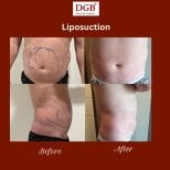 نتائج شفط الدهون قبل وبعد في عيادة DGB، تحسين واضح في شكل البطن