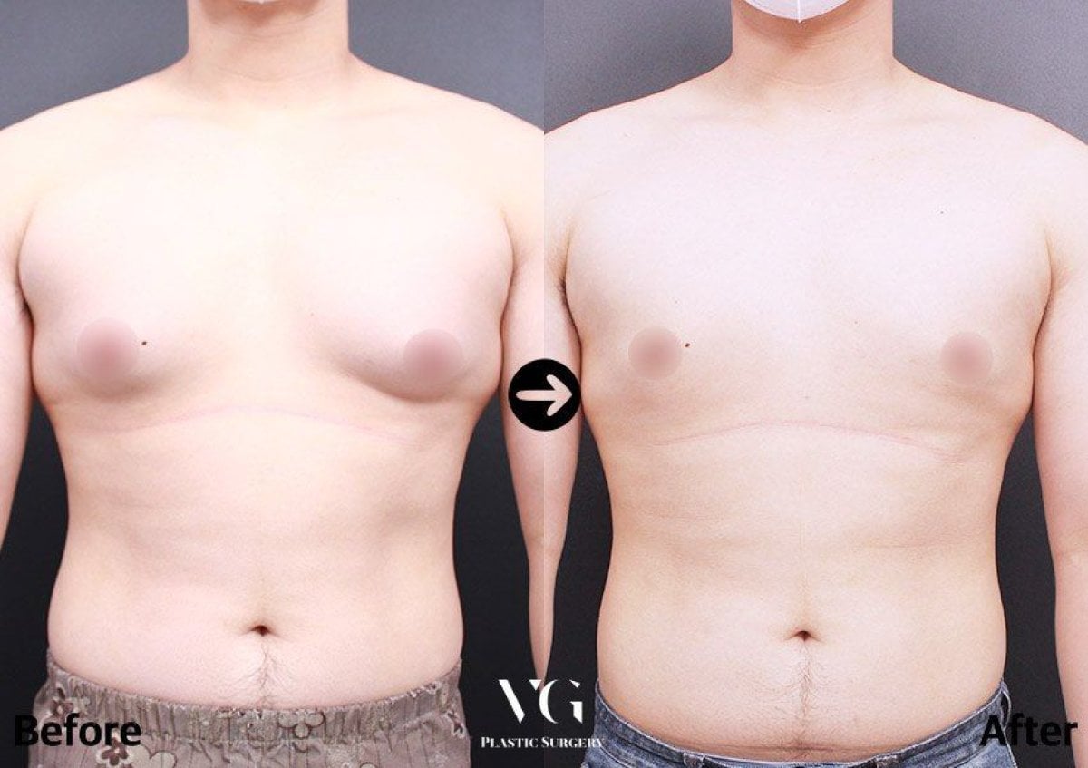 Antes y después de liposucción para ginecomastia en VG Plastic Surgery, resultado de contorno