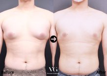 Vorher-nachher-Ergebnis der Liposuktion bei Gynäkomastie in VG Plastic Surgery, Brustkontur