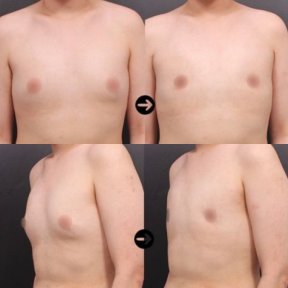 Vorher-nachher-Ergebnis der Gynäkomastie-Liposuktion bei VG Plastic Surgery, bessere Brustform
