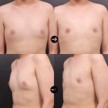 Vorher-nachher-Ergebnis der Gynäkomastie-Liposuktion bei VG Plastic Surgery, bessere Brustform