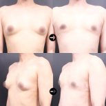 Vorher-nachher-Ergebnis der Liposuktion bei Gynäkomastie in VG Plastic Surgery, Brustkontur