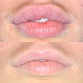Before and after lip reduction results at Memorial Şişli Hospital, improved lip contour