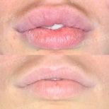 Before and after lip reduction results at Memorial Şişli Hospital, improved lip contour
