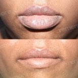 Before and after lip reduction results at Memorial Şişli Hospital, visibly slimmer lips