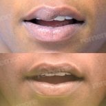 Before and after lip reduction results at Memorial Şişli Hospital, visible slimmer lips