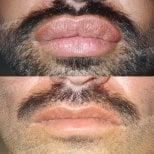 Before and after lip reduction results at Memorial Şişli Hospital, visible smaller lips