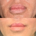 Before and after lip reduction results at Memorial Şişli Hospital, improved lip contour