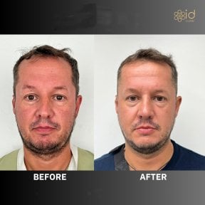 Before and after open rhinoplasty results at ID Clinic Bangkok, improved nose shape and symmetry