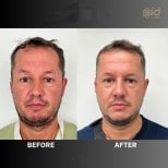 Before and after open rhinoplasty results at ID Clinic Bangkok, improved nose shape and symmetry