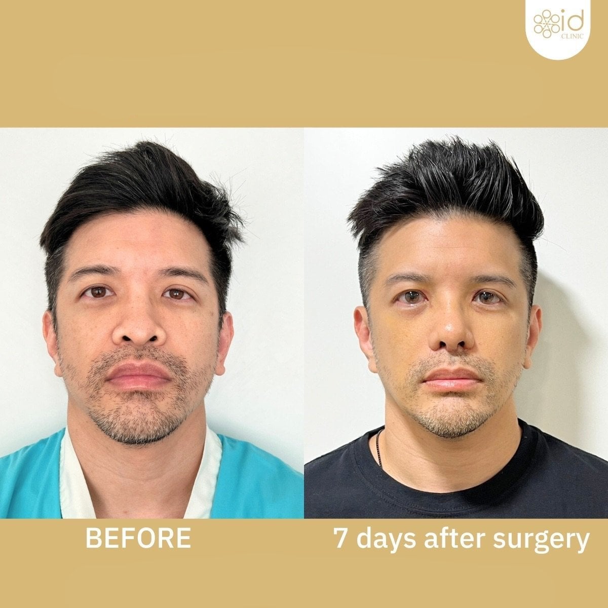 نتائج قبل وبعد عملية تجميل الأنف المفتوحة في ID Clinic Bangkok، تغيير واضح للأنف