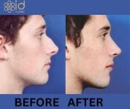 Before and after open rhinoplasty results at ID Clinic Bangkok, improved nose profile