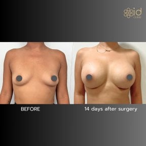 Before and after breast augmentation results at ID Clinic Bangkok, 14 days post-surgery