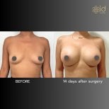 Before and after breast augmentation results at ID Clinic Bangkok, 14 days post-surgery