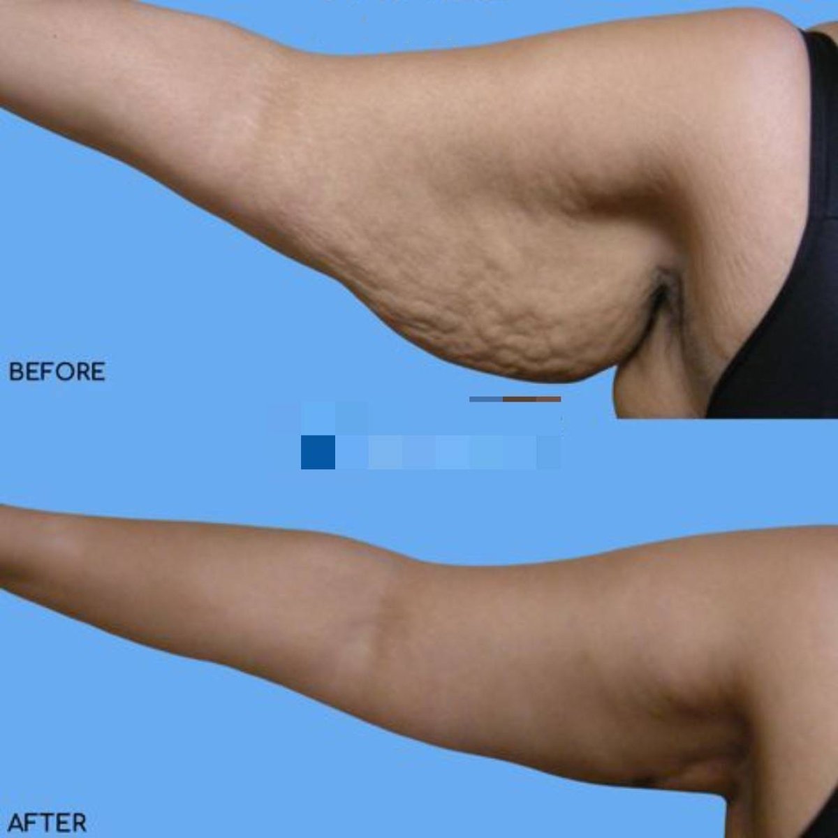 Resultado de lifting de brazos antes y después en ID Clinic Bangkok, contorno mejorado