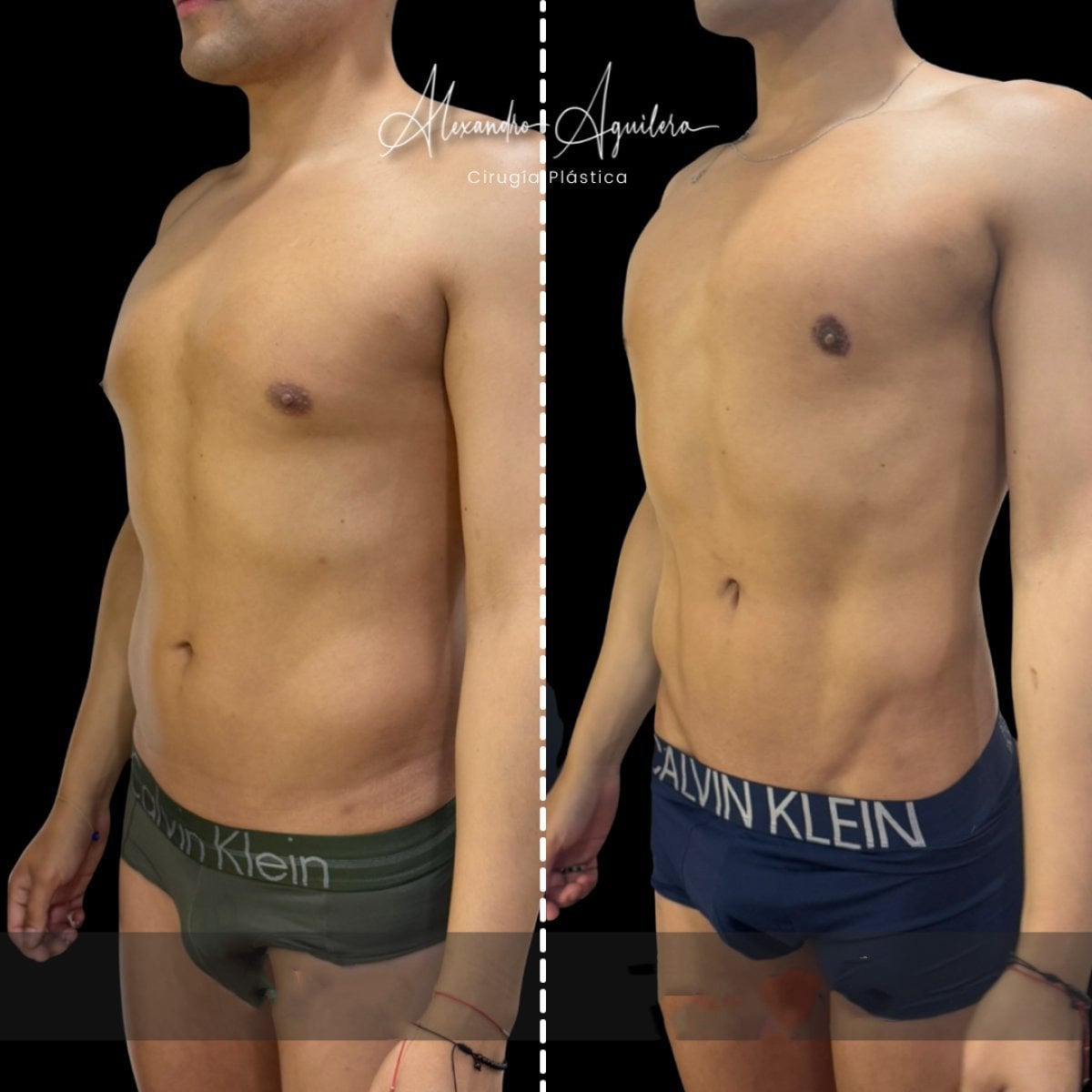 Before and after liposuction results at Dr. Alexandro Aguilera - Plastic Surgery, improved abs