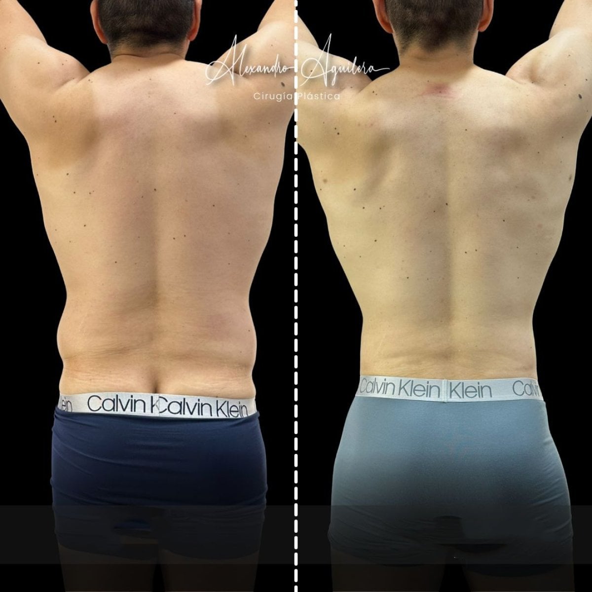 Resultados de liposucción antes y después en Dr. Alexandro Aguilera - contorno de espalda mejorado