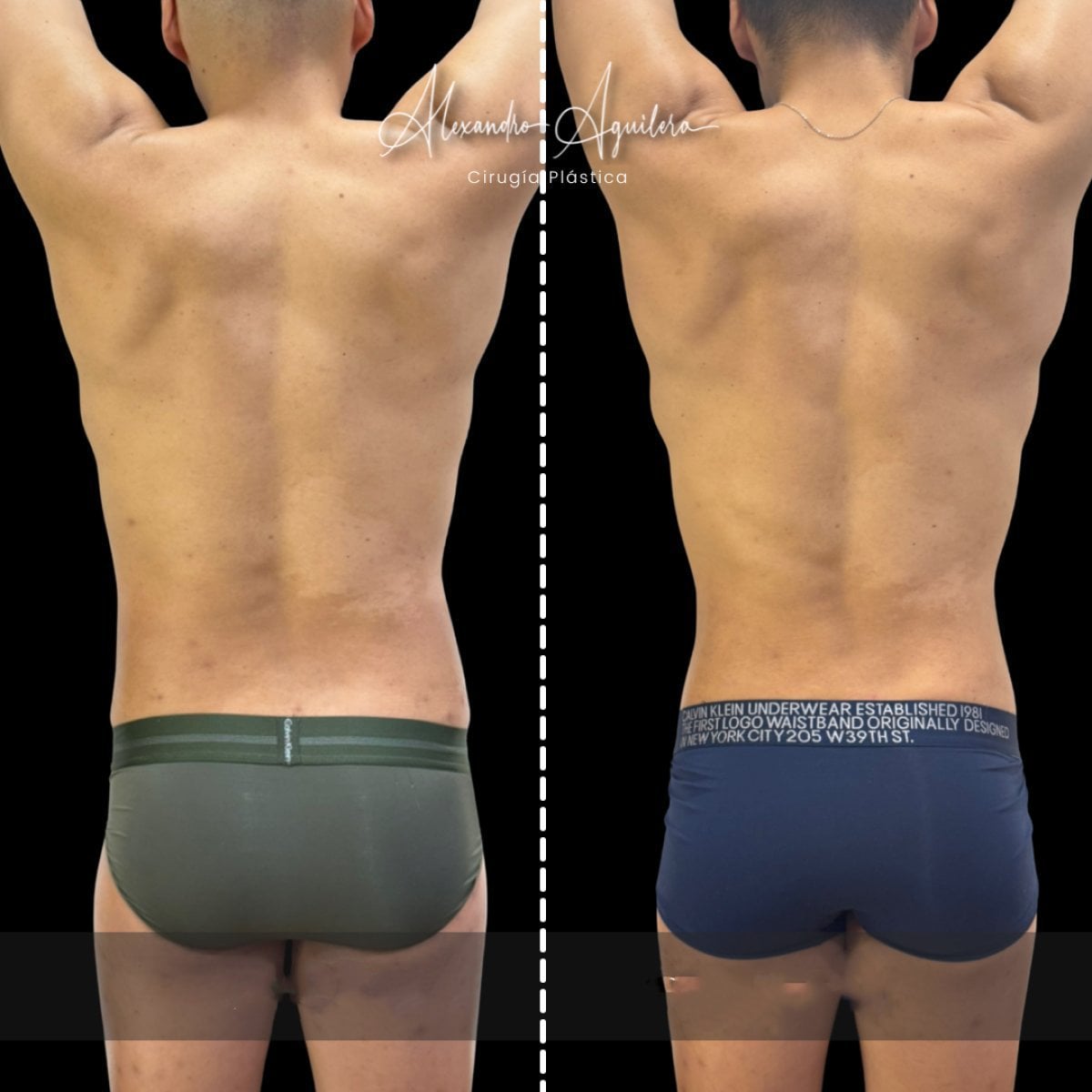Before and after 360 liposuction results at Dr. Alexandro Aguilera - Plastic Surgery, body contouring