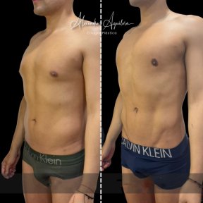 Результаты 360 липосакции до и после в клинике Dr. Alexandro Aguilera - Plastic Surgery
